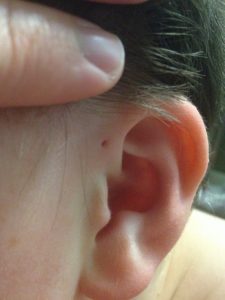 Приблизно 5% людей на планеті народжуються з невеликим отвором над одним або обома вухами