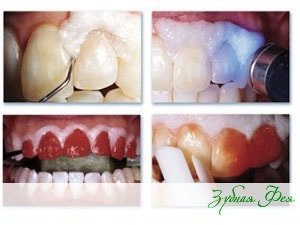 Система клінічного відбілювання Opalescence Boost - рішення для людей, які хочуть швидко та безпечно освітлити емаль зубів