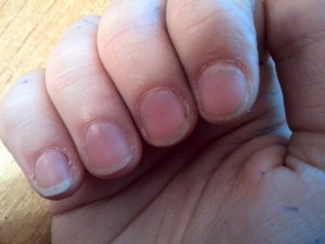 Серед усіх причин, за якими сохне шкіра навколо нігтів на руках, можна особливо виділити наступні: