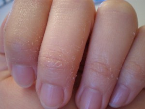 Якщо шкіра навколо нігтів вже лущиться, то це зможе знизити інтенсивність явища