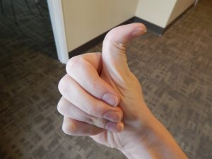 Вигнутий великий палець - фізіологічне явище, при якому верхня фаланга великого пальця може зігнутися на 90 градусів в напрямку, протилежному долоні